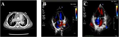 Case Report: Identification of microduplication in the chromosomal 2p16.1p15 region in an infant suffering from pulmonary arterial hypertension